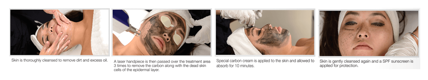 Carbon Facial