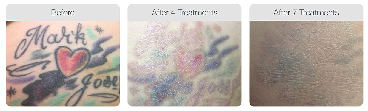 tatto removal