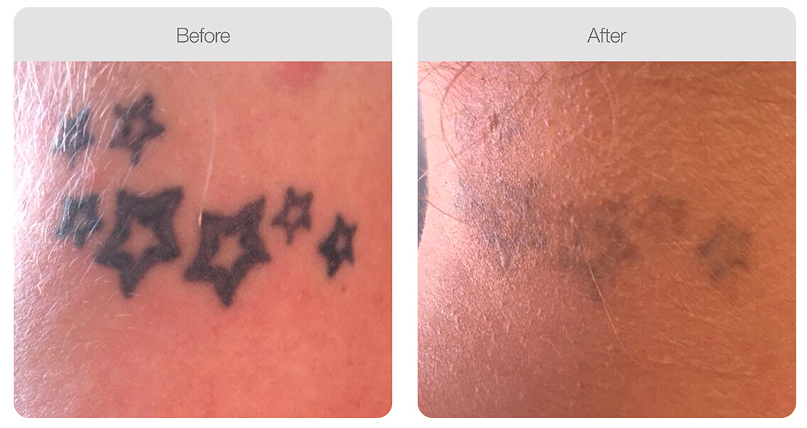 tatto removal