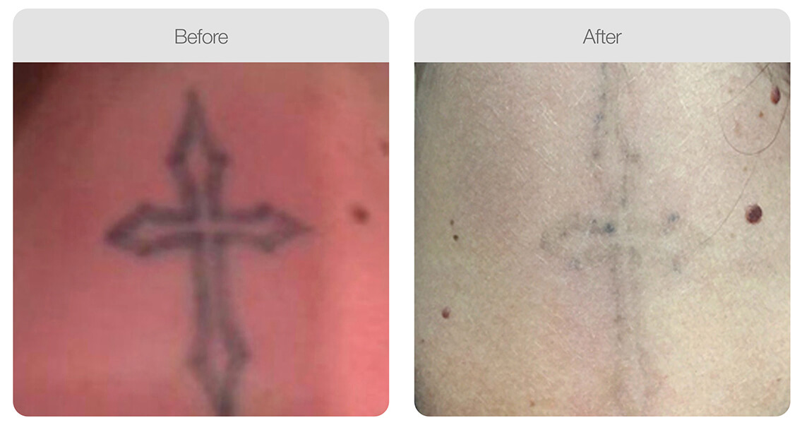 tatto removal