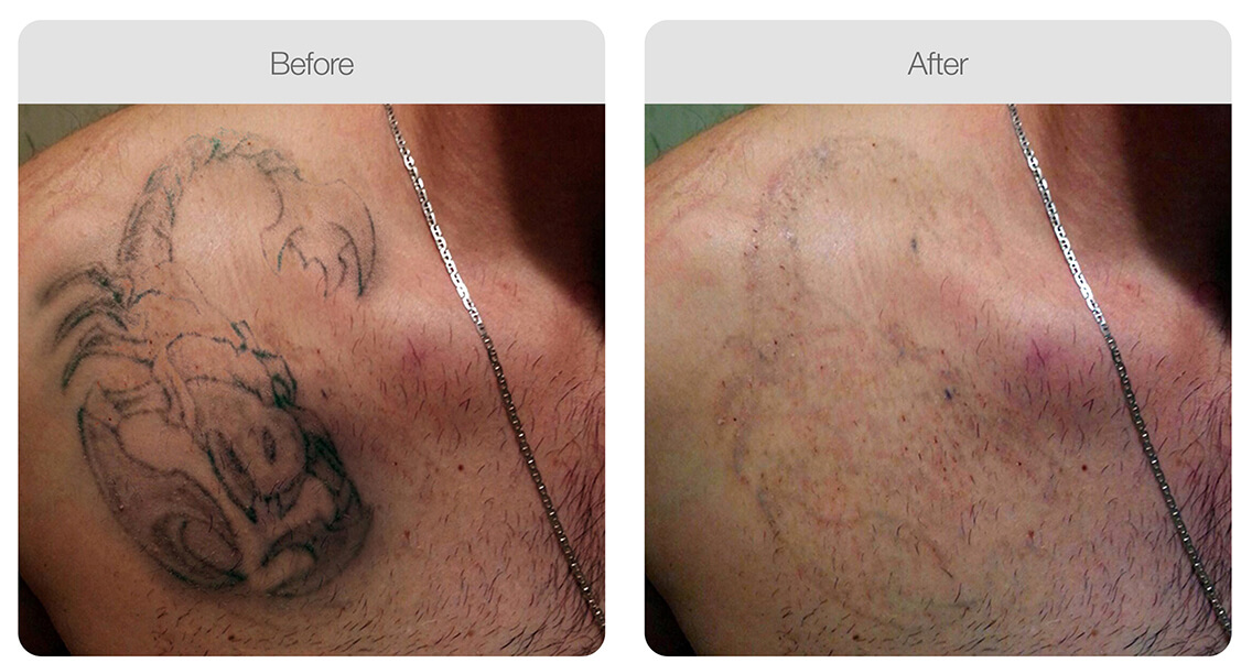 tatto removal